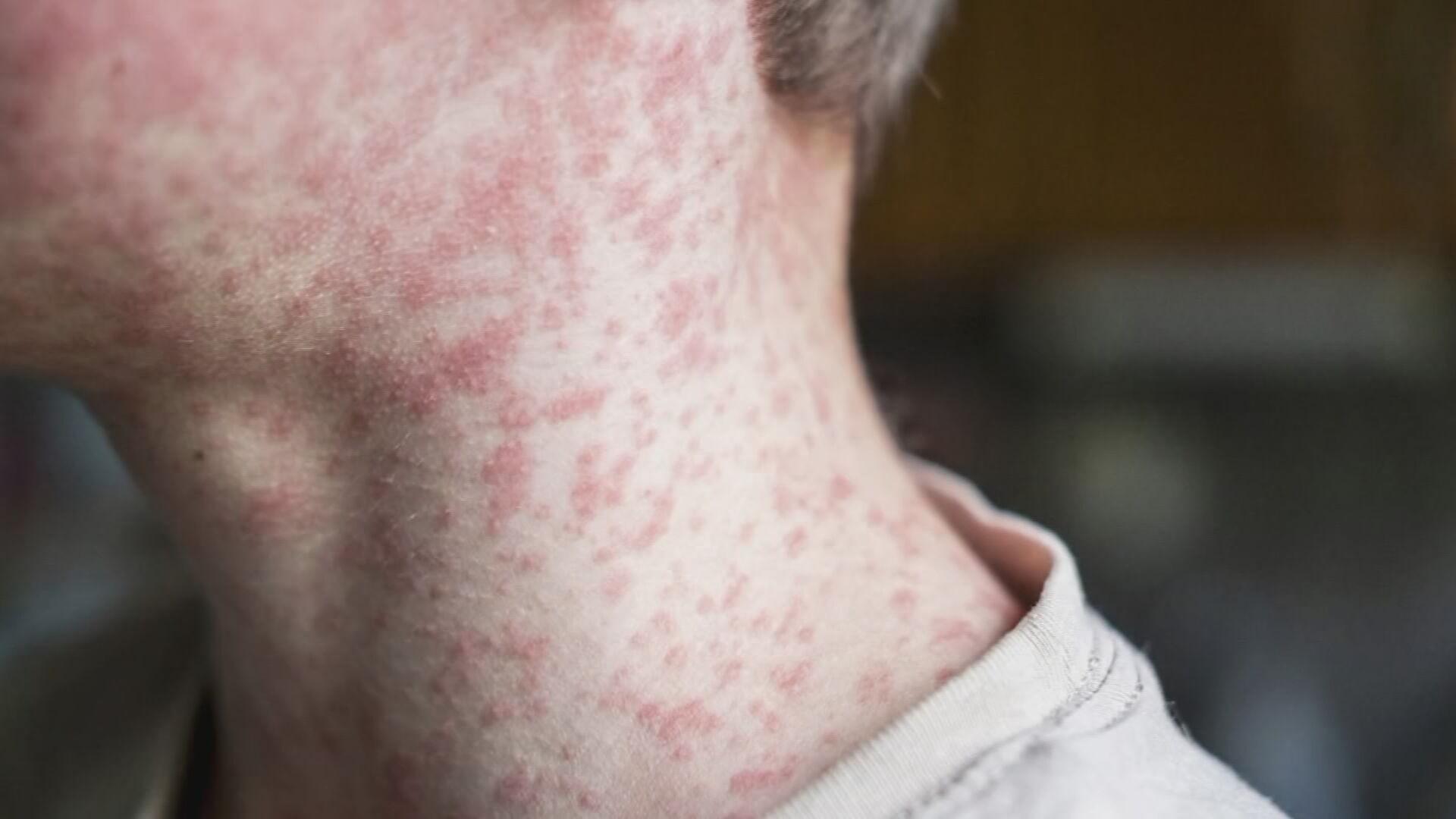 Oklahoma health officials jeopardize the meslusa at low vaccination