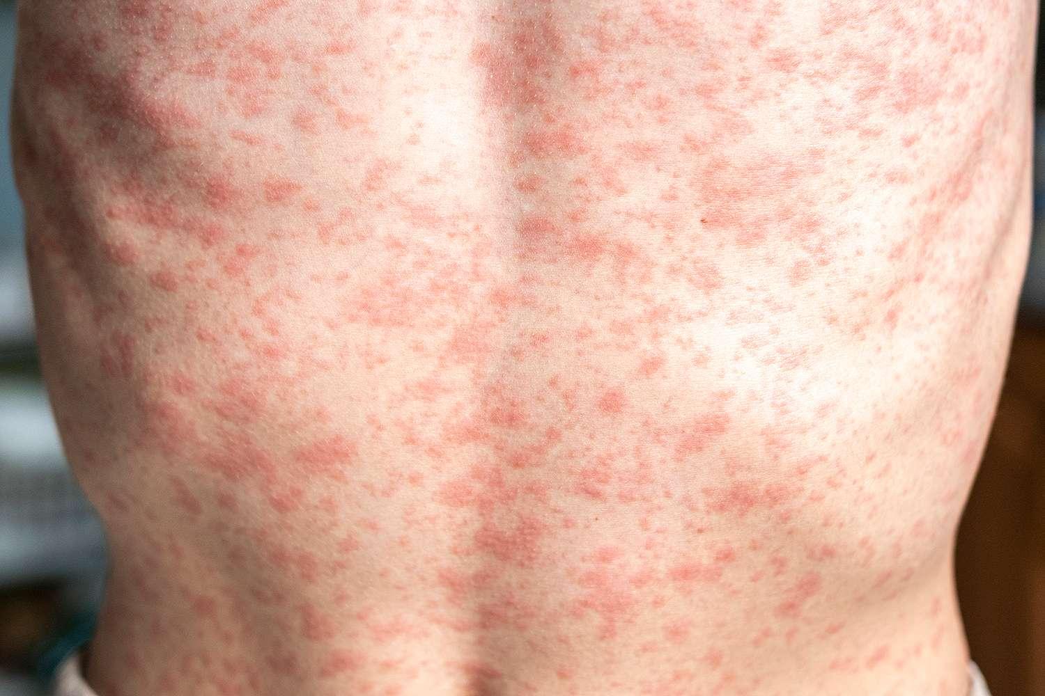 When Texas proclaims a measles outbreak, Denver airport announces exposure